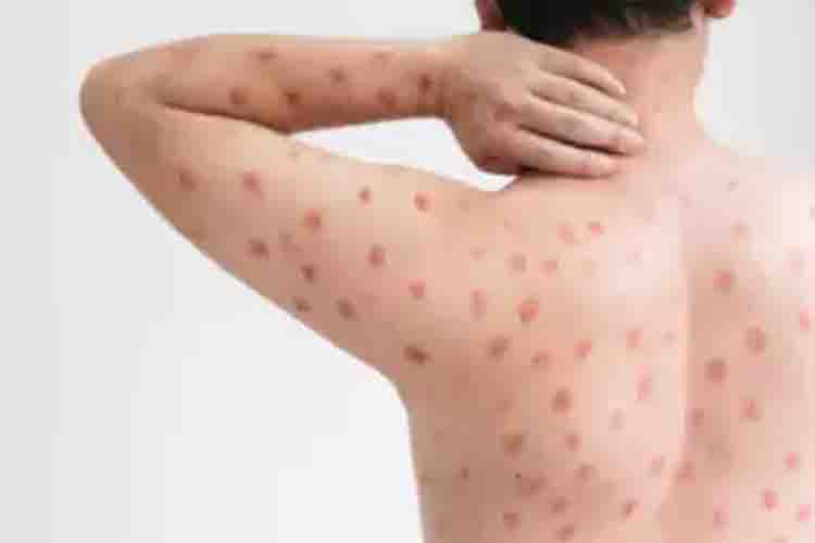 Monkeypox detected in man who came to Kerala from UAE