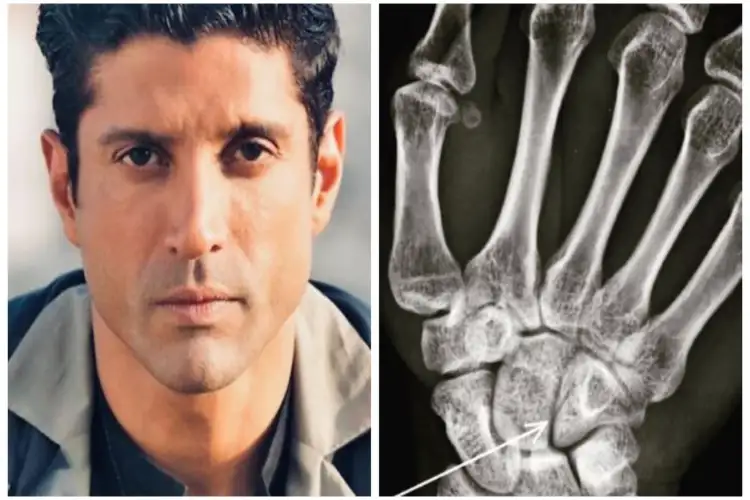 Farhan Akhtar on recovering from meniscus tear and surgery: Life’s getting back on track